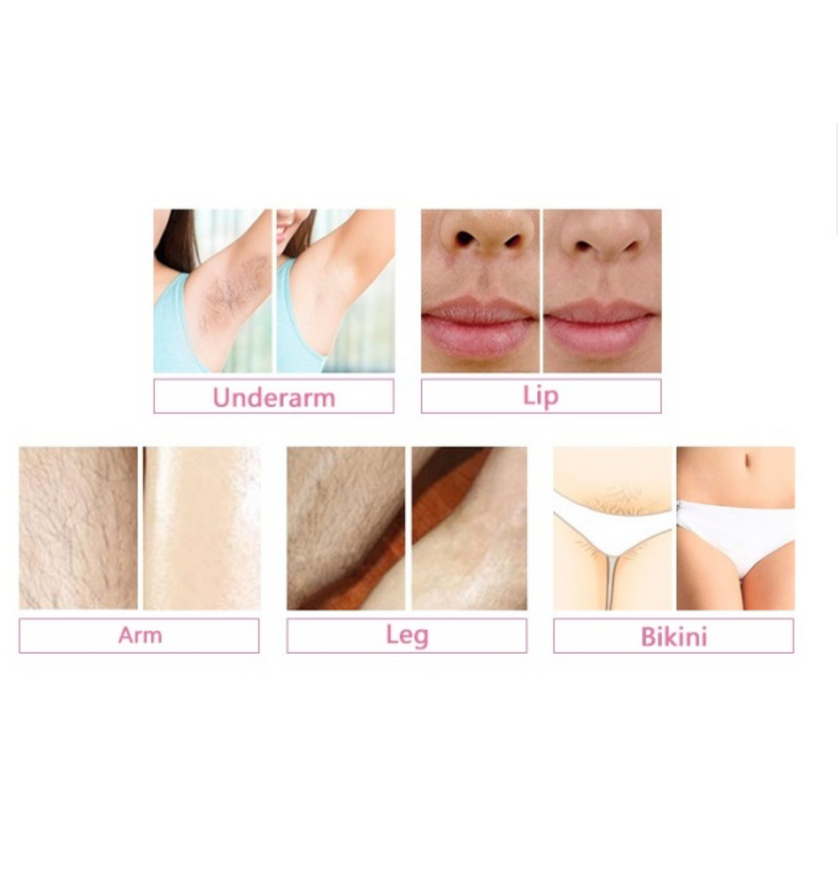 Portable diode laser hair removal equipment with 3 wavelengths: 755nm, 808nm and 1064nm.