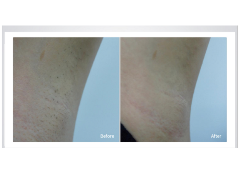 Professional Painless Laser Hair Remover 10 Million Shots, 1200W High Power, 808nm Diode Laser Hair Removal Equipment.