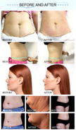 5 Handle Cryolipolysis Slimming Machine - OSTEOPHARMA™