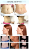 5 Handle Cryolipolysis Slimming Machine - OSTEOPHARMA™